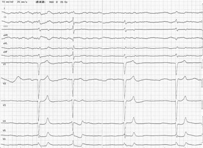 Case report: A case of bradycardia triggered by diarrhea